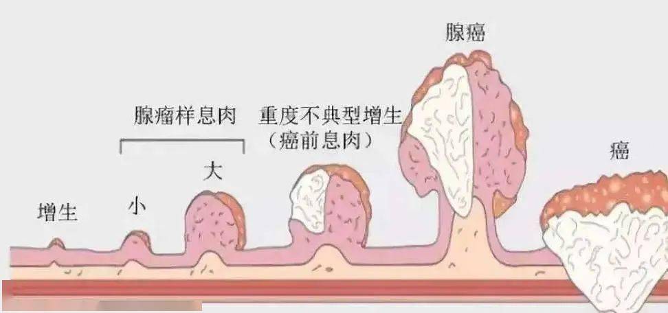 发现胃息肉都要及时切除吗