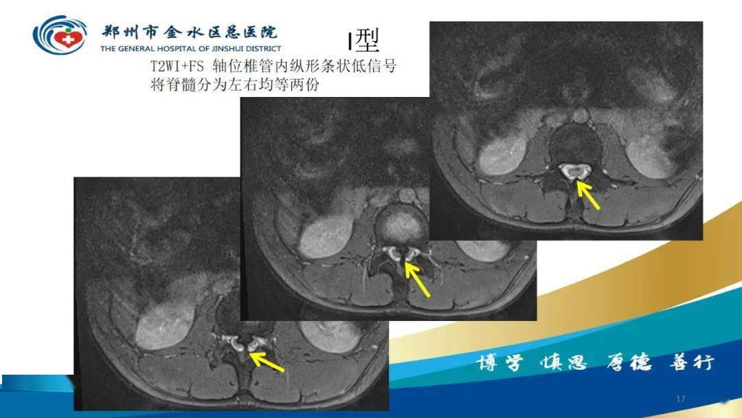 脊髓纵裂及相关疾病影像表现
