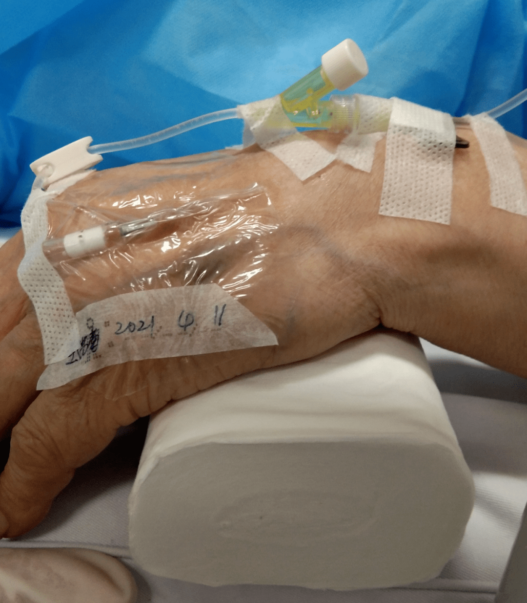 留置针打在这种奇葩位置合适吗?小心摊上大事_静脉_活动_宝宝