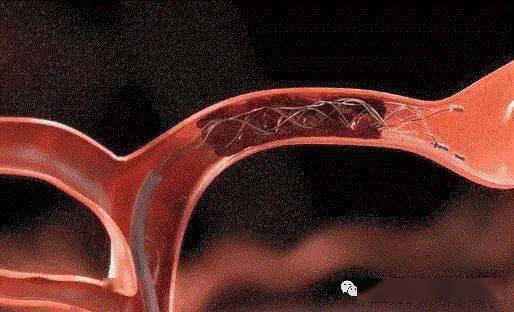 疏通脑血管我们在行动记唐山海港医院神经内科脑血管疾病介入治疗