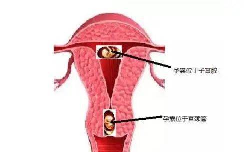 子宫_宫颈_治疗