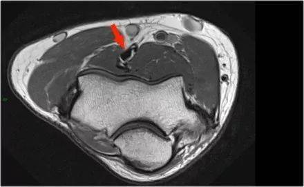 桥臂解剖MRI图片