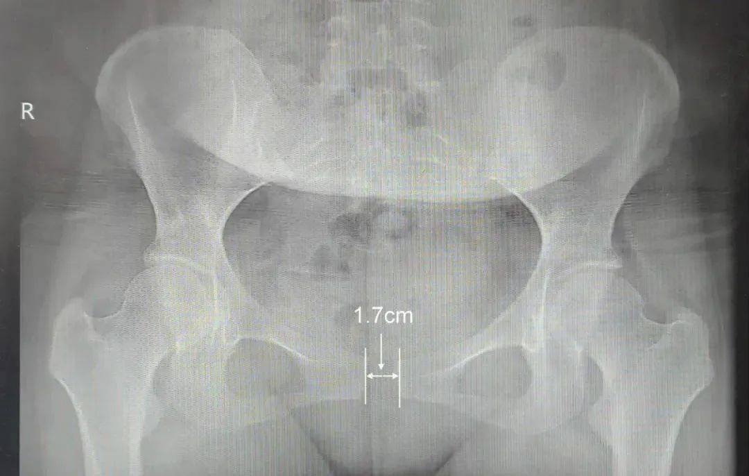 耻骨联合x光片图片
