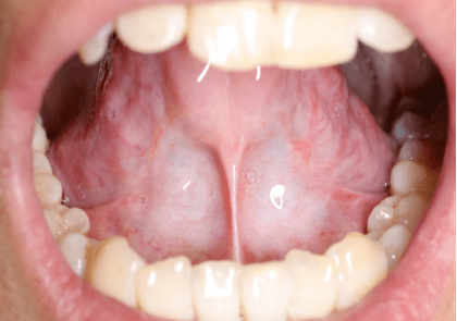【口腔科普】慎点!某人经常吃槟榔,这是他的口腔黏膜发生的变化