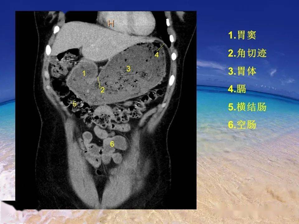 消化道穿孔ct影像大汇总看完印象深刻