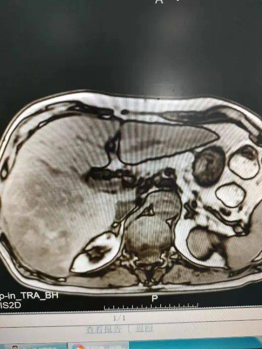 2021-04-18行上腹部增强磁共振检查提示:1,肝右叶肿瘤性病变,考虑肝癌