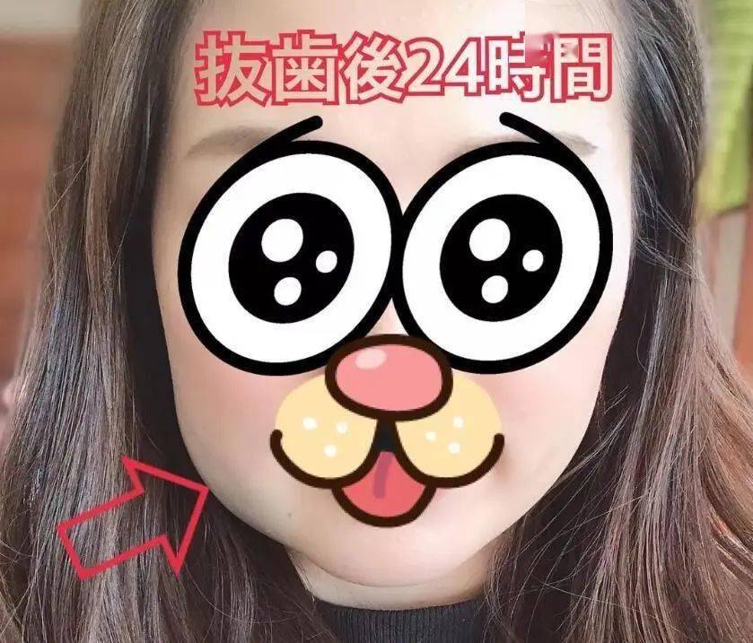 一口气拔掉四颗智齿猛男秒变萌男这是一篇让人欢乐的文章