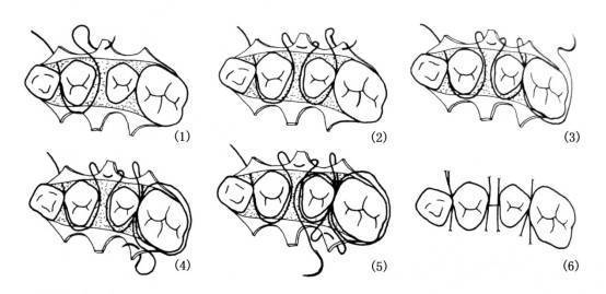后牙锚式缝合图片
