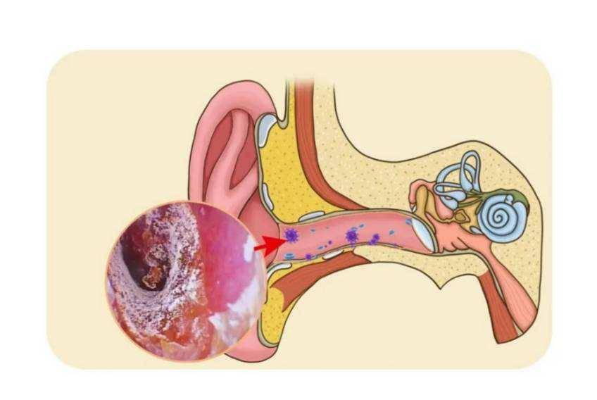 耳朵总是奇痒无比,究竟是怎么回事?