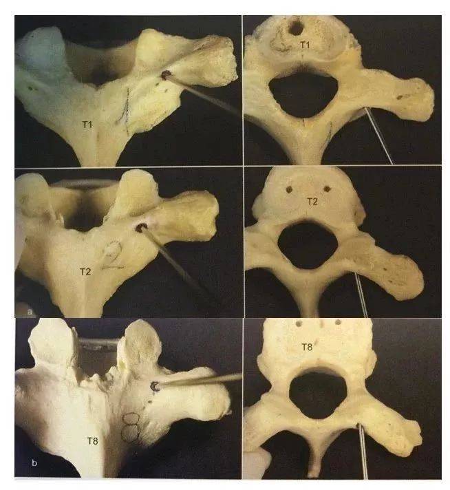 收藏丨胸椎、颈椎、腰椎椎弓根置钉技术