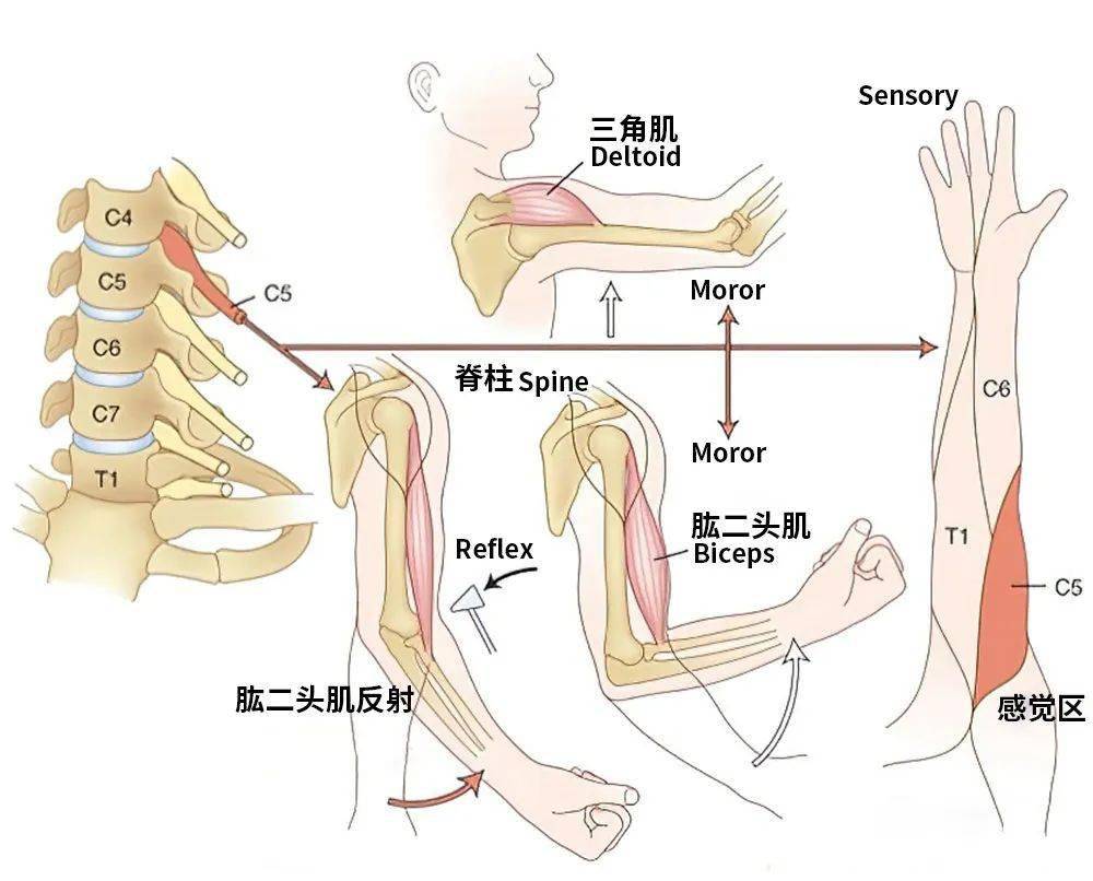 首先是颈5神经根,颈5神经根受压或者刺激时疼痛主要出现在肩部和上臂