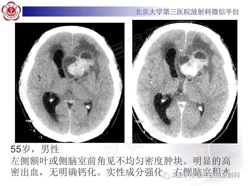 头颈系统超全影像文章汇总全网最全头颅影像解剖学,不容错过(更新版)