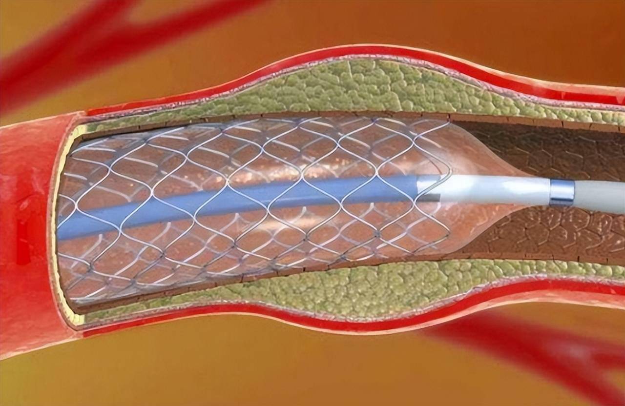 进口血管支架图片