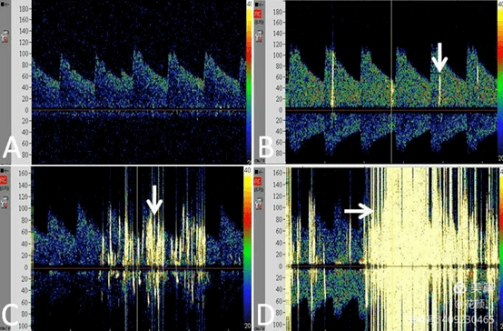 健康科普小气泡立大功tcd发泡试验