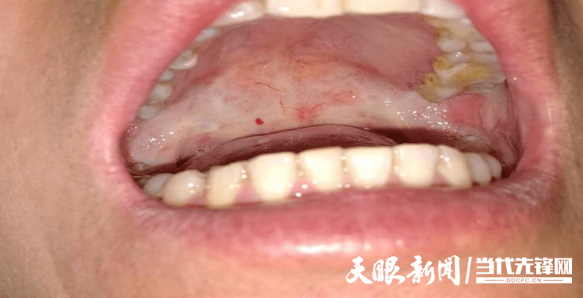 吃刺激物疼痛,口腔黏膜起疱,张口困难等,常常是咀嚼槟榔患者到口腔