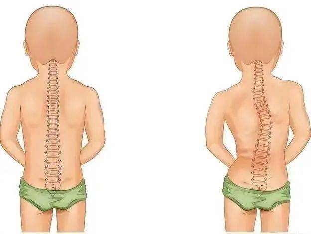 儿童青少年脊柱弯曲异常如何防控