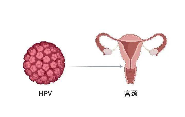 擴散感染了hpv病毒就是得了宮頸癌