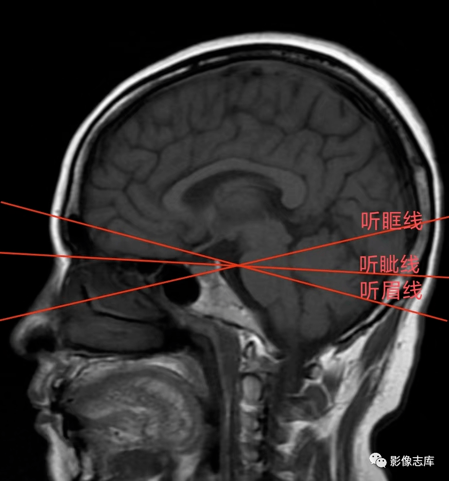 ct头部扫描定位线图片图片