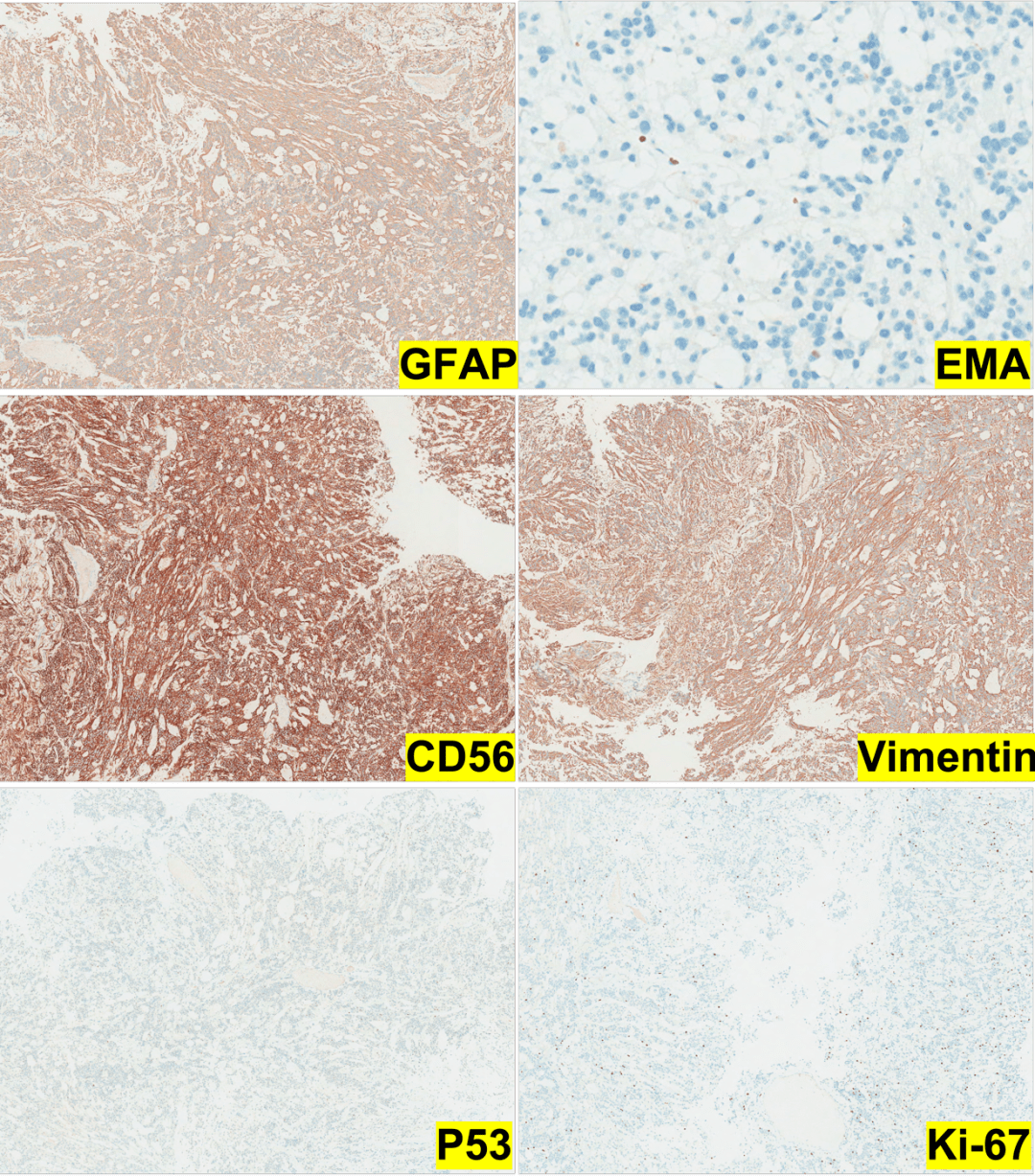 病例分享黏液乳头状室管膜瘤一例神经病理系列十四浙二神外周刊第352