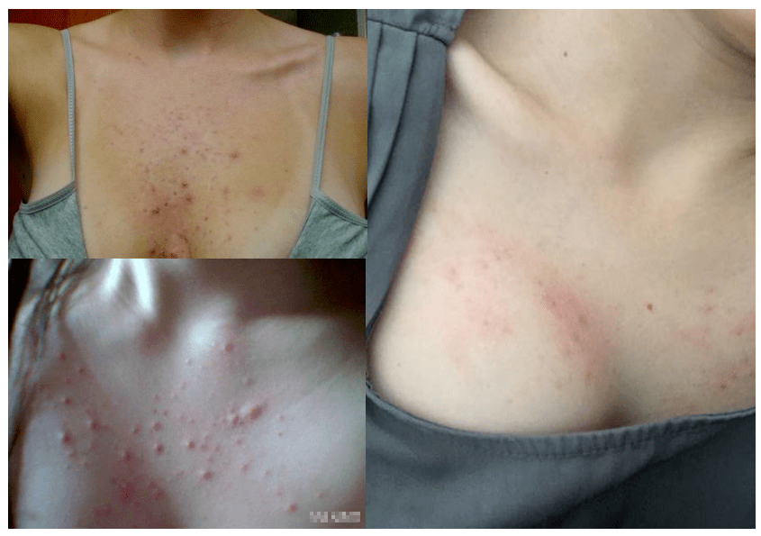 更可怕的是胸部长期处在闷热潮湿的环境下,还非常容易滋生螨虫和细jun