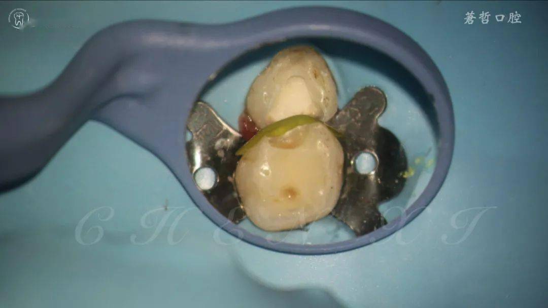 乳牙根管形态图片