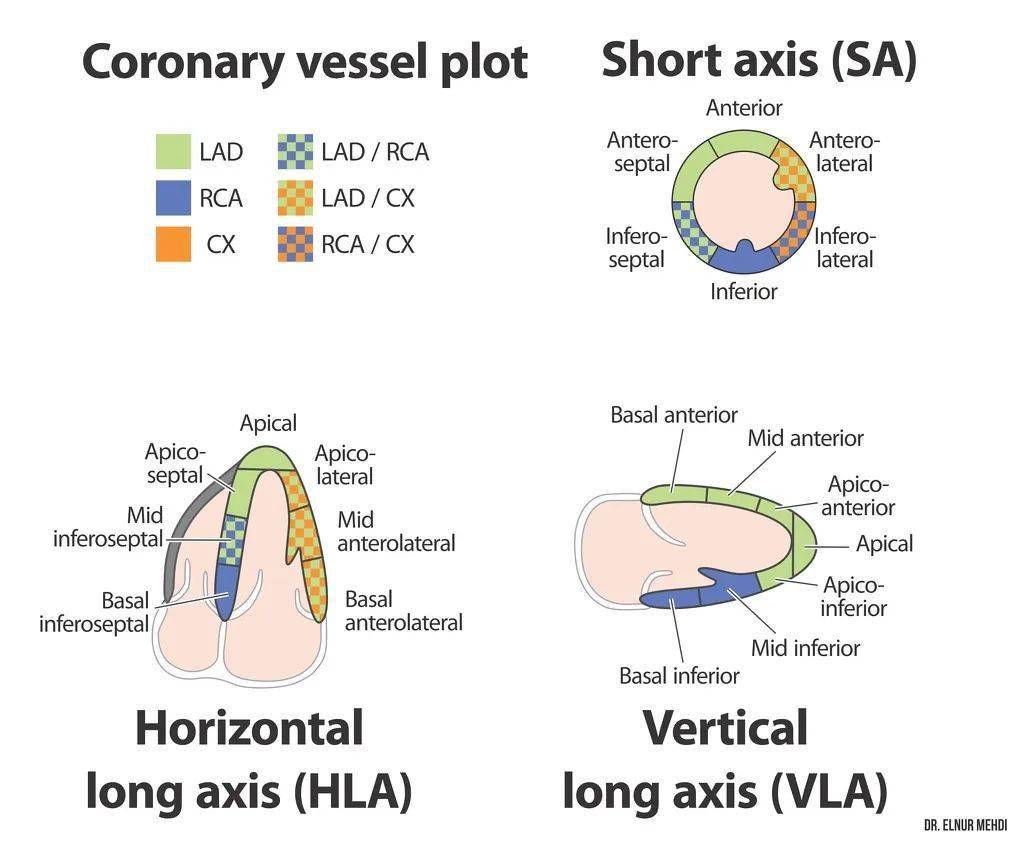 13,14 和 17 段供血(蓝色区域)冠状动脉供血区域左心室心尖部心肌节段