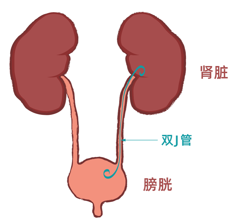 豬尾巴導管是什麼