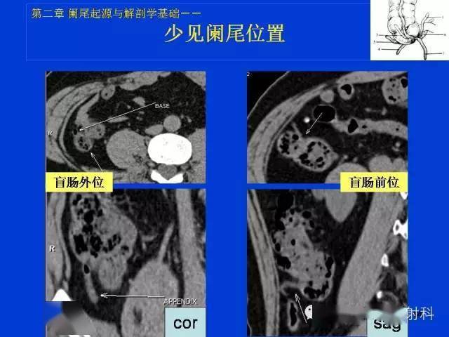 阑尾ct图解图像图片