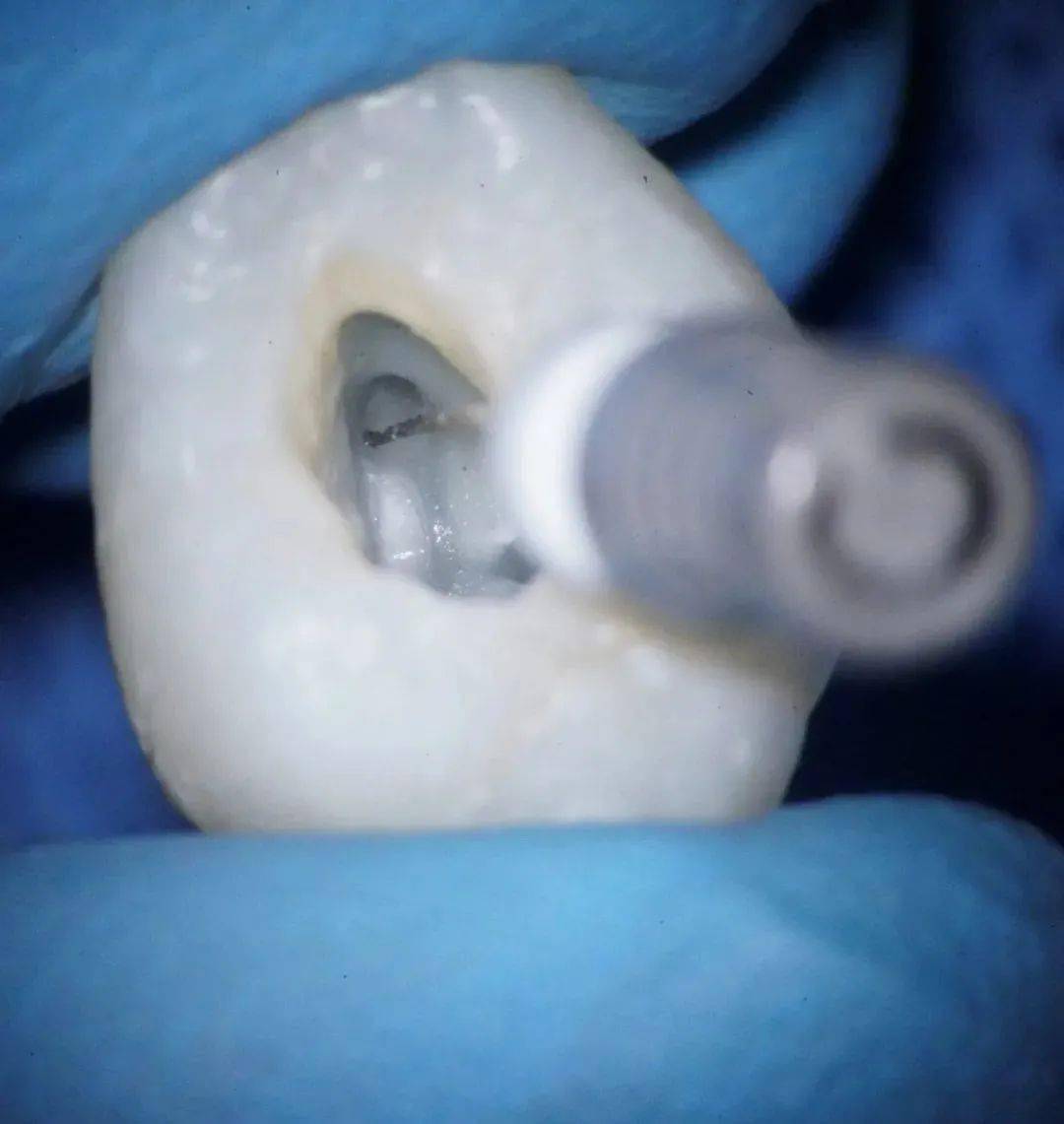 大家闻风丧胆的"抽神经",到底是种什么体验?_治疗_牙齿_进行