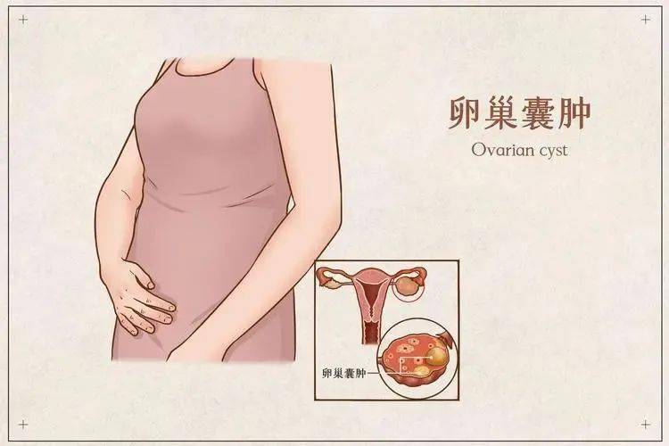 女性外阴囊肿的症状图片