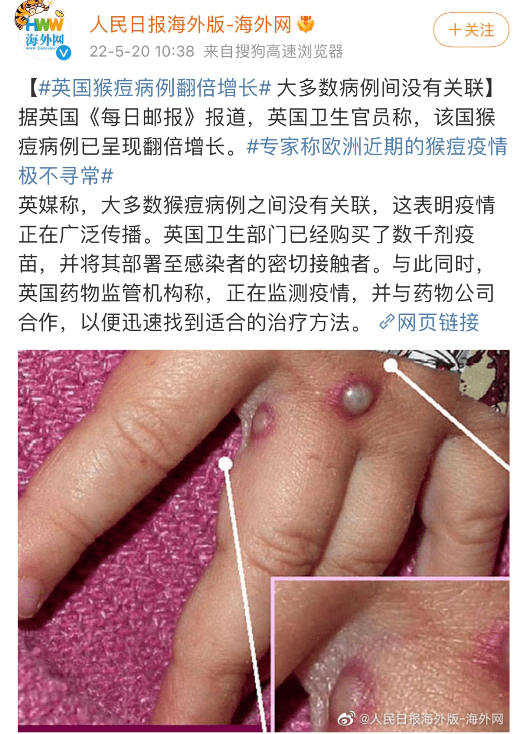 自进入5月份以来,一种原本只流行于非洲西部和中部的猴痘病毒,突然