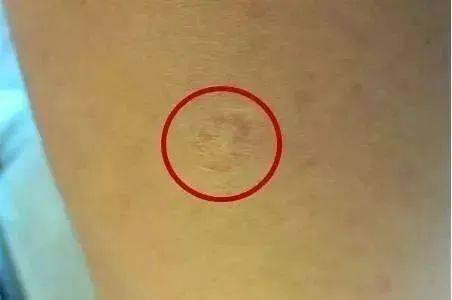 胳膊上的花是预防天花的吗猴痘牛痘天花水痘有何区别