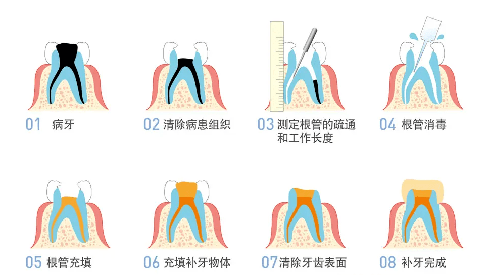 做根管治疗真嘞会痛得怀疑人生迈