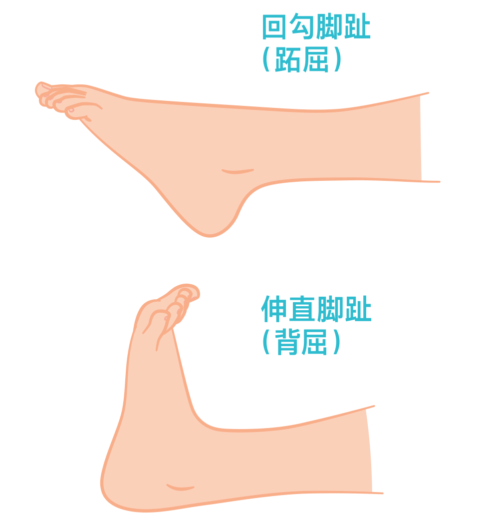 足部背伸受限图片