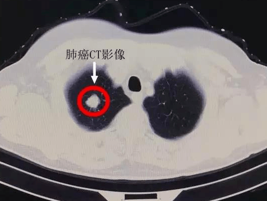 早期肺癌ct图 影像学图片