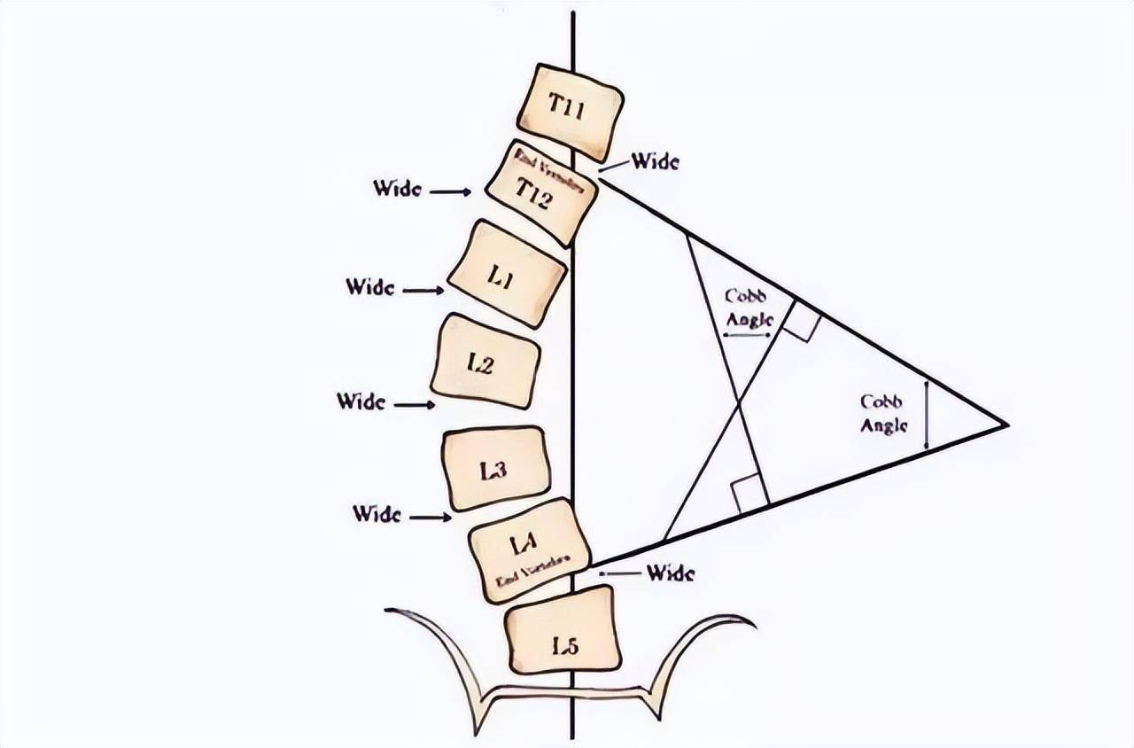 脊柱侧弯cobb角分级图片