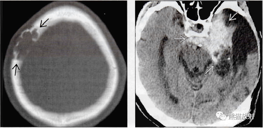 (左)轴位骨ct显示一例板障内表皮样囊肿的典型表现,病变外观呈膨胀性