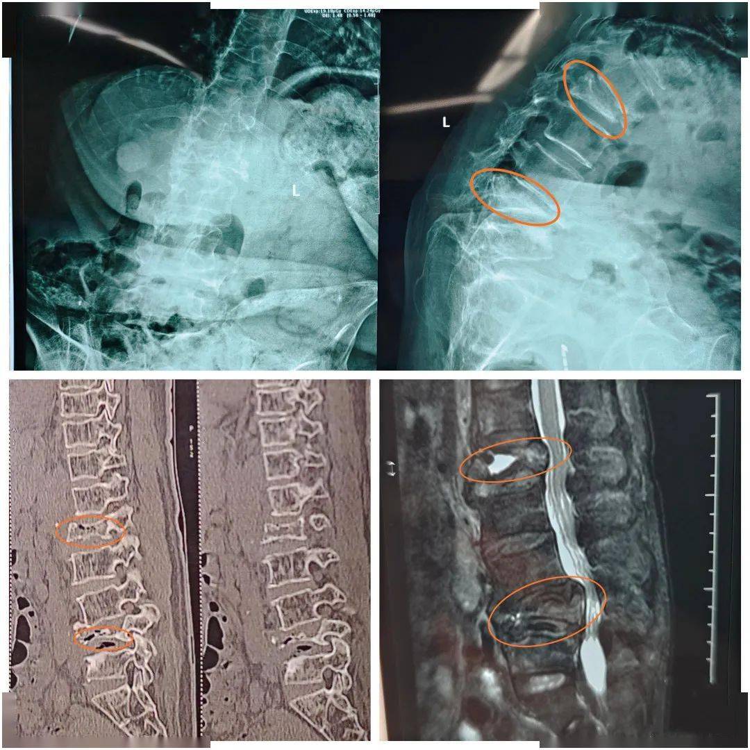 入院后,经过详细检查后,周阿姨被诊断为重度骨质疏松症合并腰椎多发性