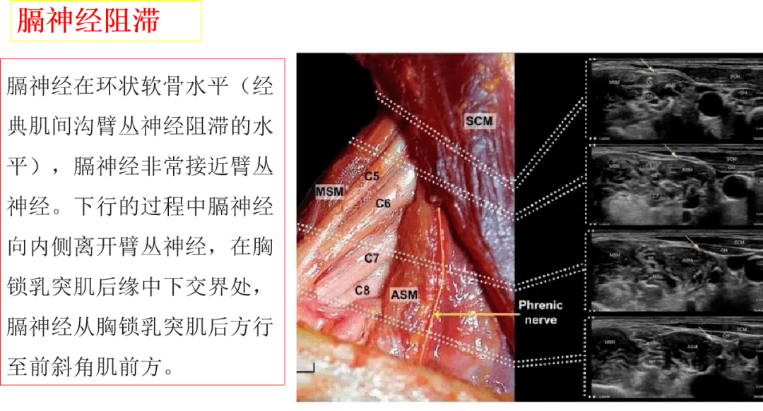 前锯肌神经阻滞超声图图片