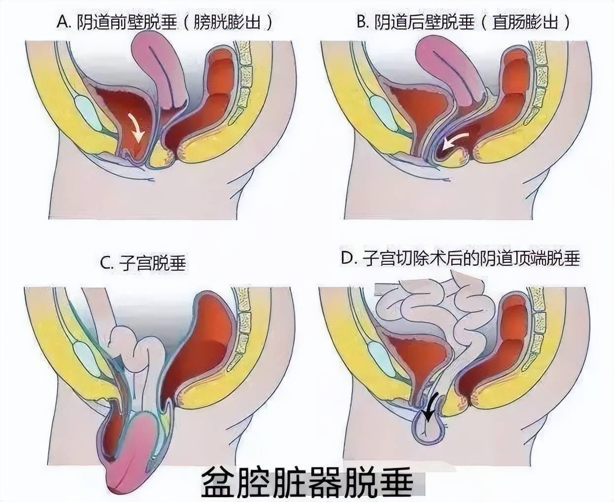 關於脫垂手術,你想知道的都在這兒