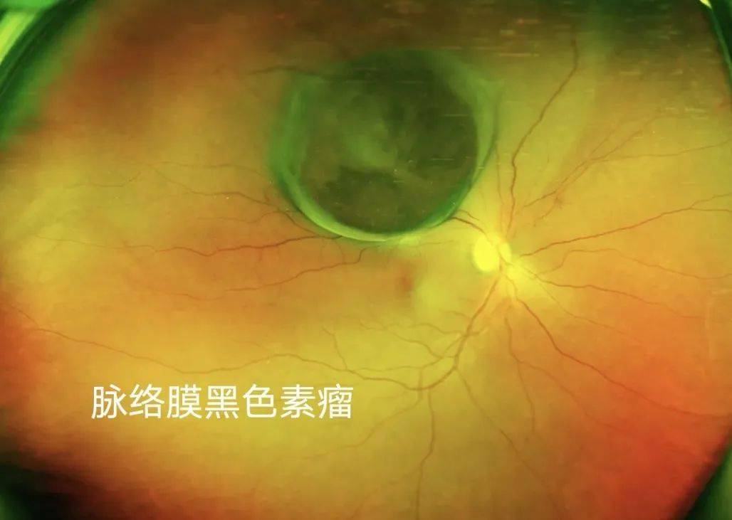 全国爱眼日眼底一张照眼病早知道