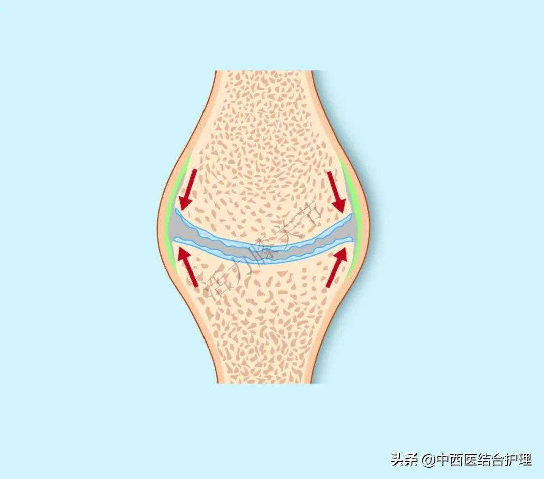 软骨_膝关节_磨损
