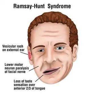 根据罕见疾病数据库,亨特氏综合征(rhs,ramsay hunt syndrome) 是一种