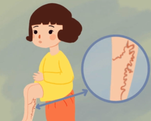 久站久坐是静脉曲张最大诱因,二院普外科微创介入治疗下肢静脉曲张