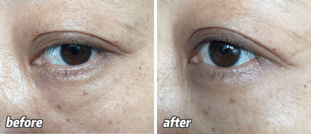 守住变老的第一道防线,眼纹泪沟女孩看这里!_眼袋_效果_细纹