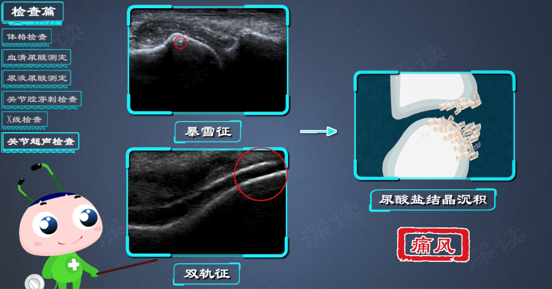 抗炎镇痛降尿酸?手术取石?痛风治疗门道多,全解读_关节_药物_检查