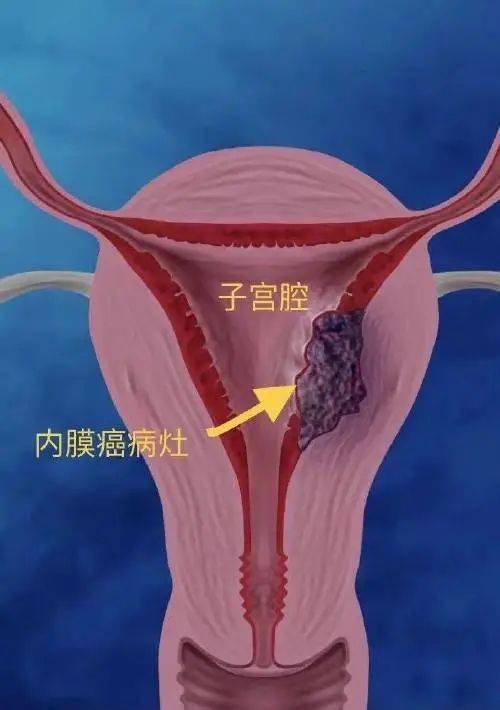 这样滴:异常子宫出血病因分类2011年figo将aub病因分为两大类9个类型