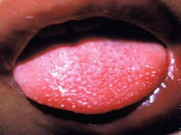 小小疹子不可忽视皮肤问题可大可小