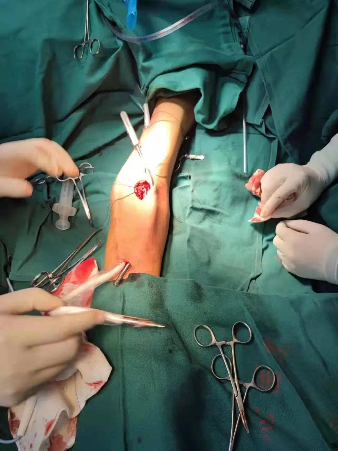 透析中心为该患者行右上肢人工血管动静脉内瘘成形术,手术过程顺利,术