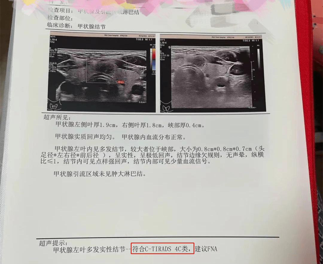 一年又一年甲状腺结节从2级到4c中医表示已无能为力